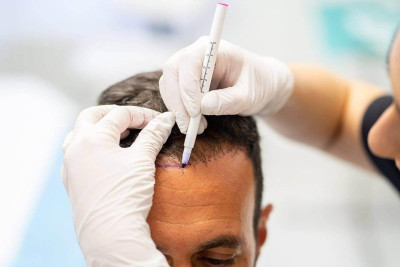 Best Place for Hair Transplant