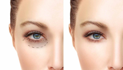 Fox Eye Surgery