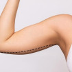 Arm Lift