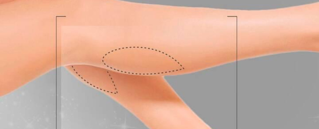Calf Implant