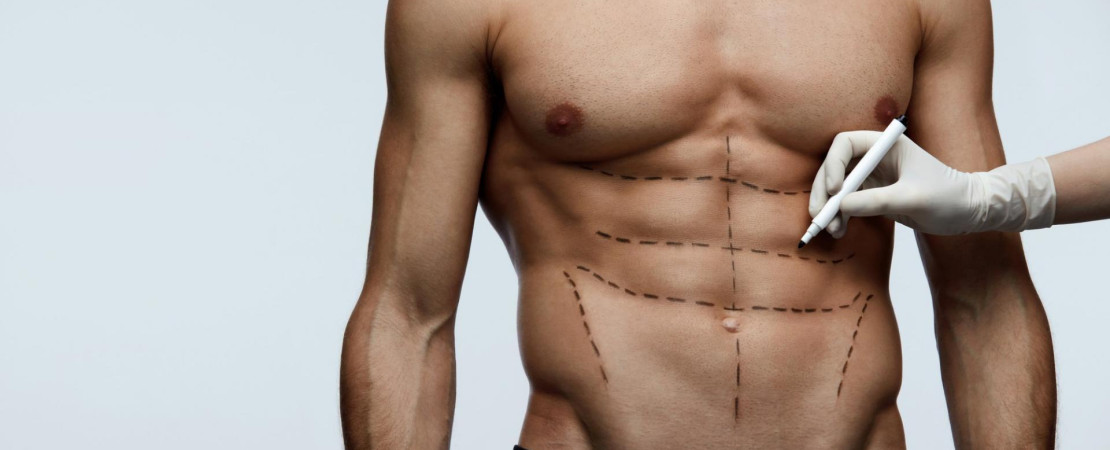 Abdominal Etching with High-Def Liposuction