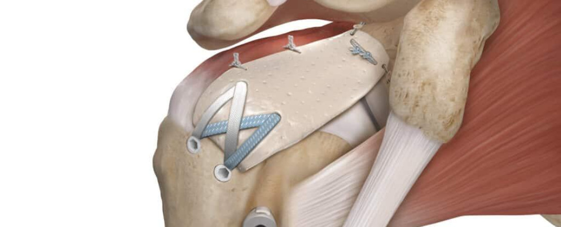 Shoulder Rotator Cuff Repair