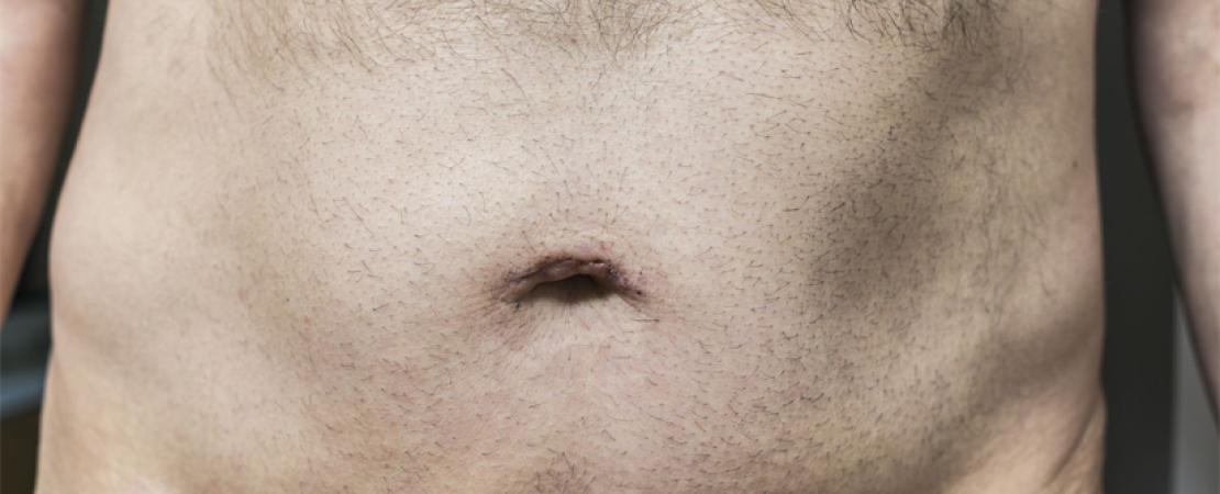 Hernia Repair Surgery