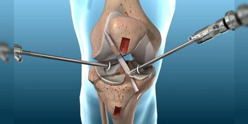 Arthroscopic Meniscus Treatment