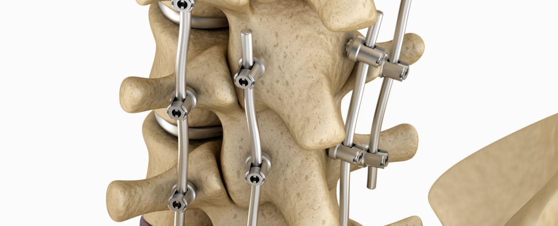 Spinal Fusion Surgery