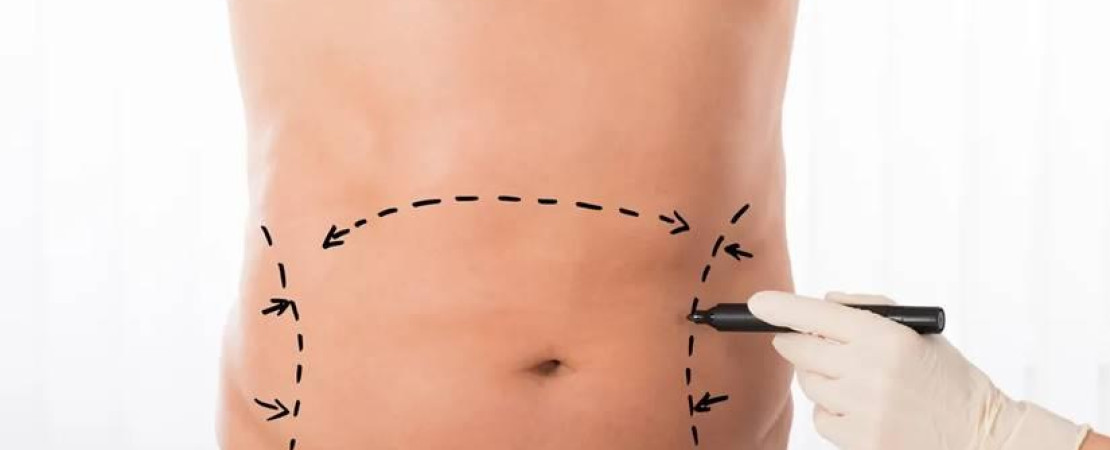 Male Liposuction