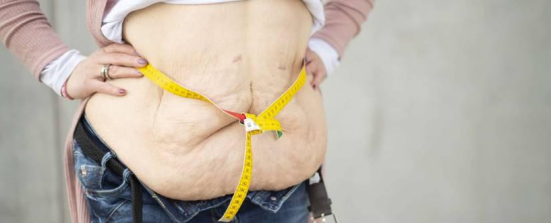 Sleeve Gastrectomy Surgery