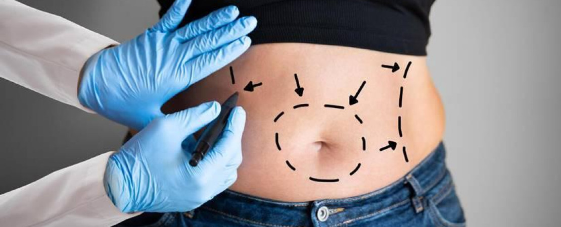 Fleur De Lis Tummy Tuck