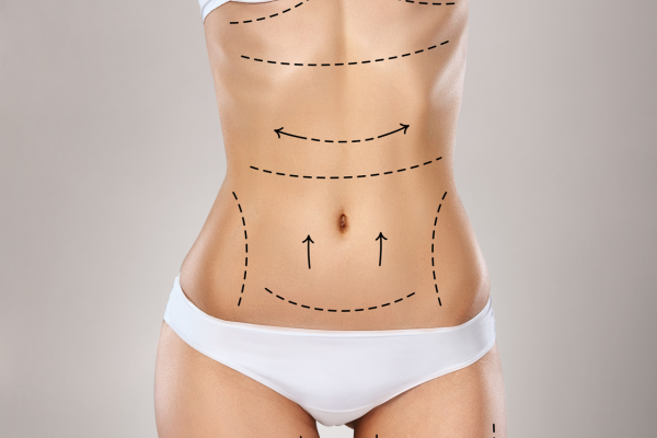 Vaser Liposuction (3 Major Areas)