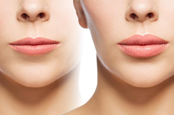 Lip Lift