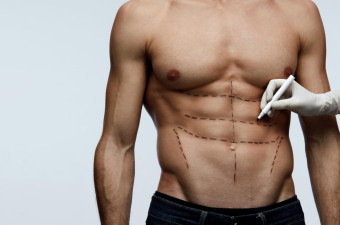  Abdominal Etching with High-Def Liposuction