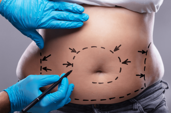 Liposuction