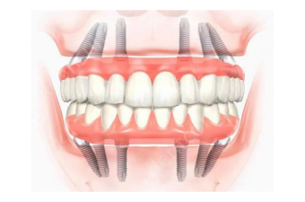 All on Four Implant Treatment
