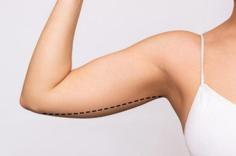 Arm Lift