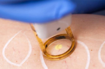 Varicose Vein Laser Surgery