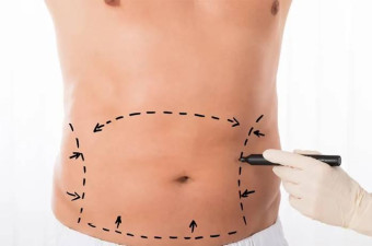 Male Liposuction