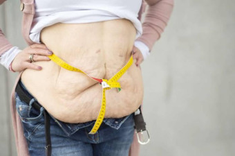 Sleeve Gastrectomy Surgery