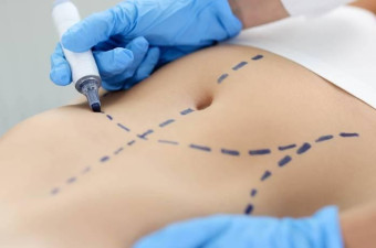 Reverse Tummy Tuck