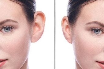 Ear Correction