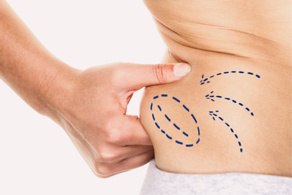 Liposuction in Turkey