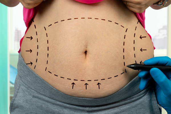 Traditional Liposuction vs Vaser Liposuction