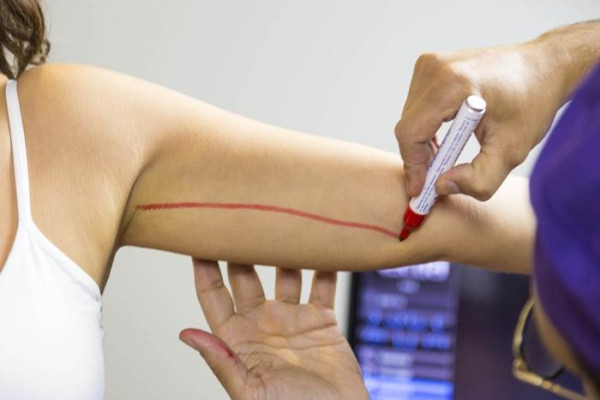 What is Arm Lift Surgery?