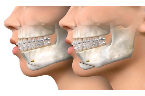 What is Cheek Implants?