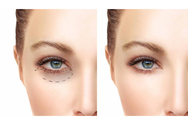 Fox Eye Surgery