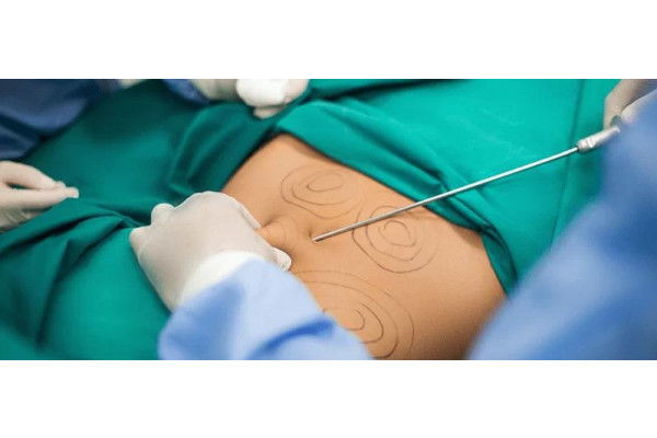 How Much Weight Can You Lose with Liposuction?