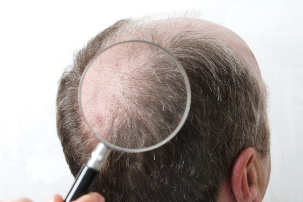 Hair Transplant Techniques