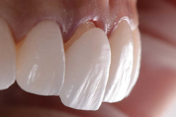 Veneers: The Permanent Smile Makeover
